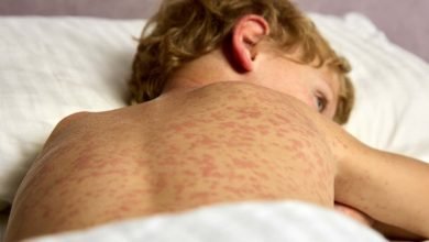 تنتشر الحصبة في جميع أنحاء الولايات المتحدة – إليك ما تحتاج إلى معرفته